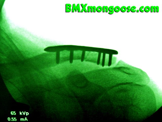 Six Thousand Dollar Man - Broken Clavicle Post Op